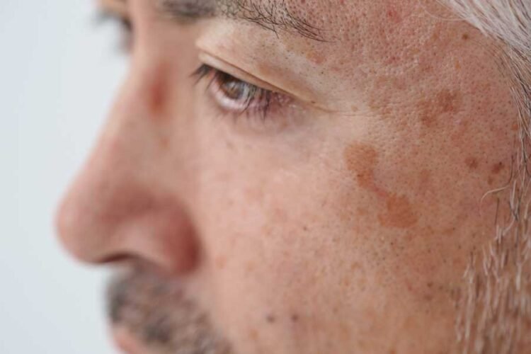 altersflecken